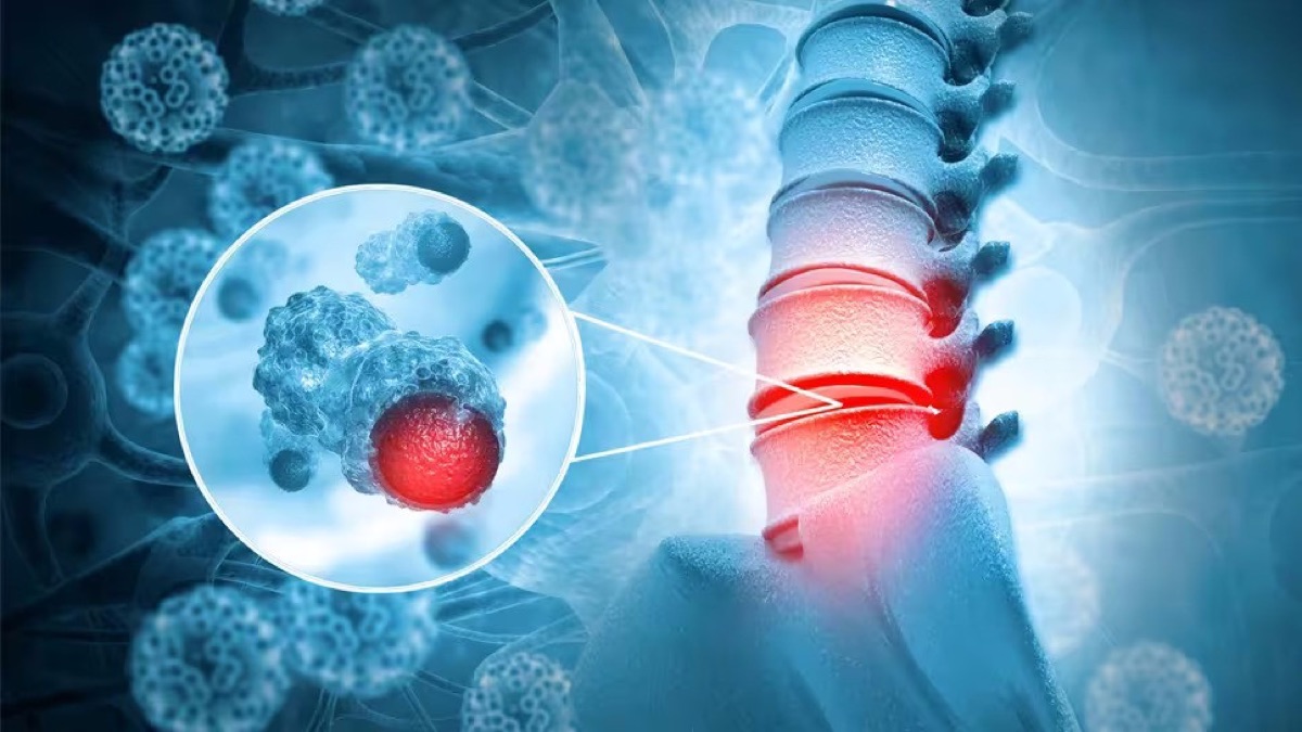 Linear accelerator delivering liver SBRT